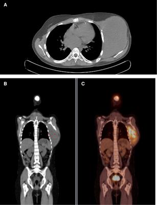 Desmoid tumour of the chest wall in paediatric post-operatory of heart transplant